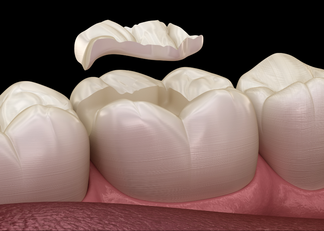 Teeth Filling